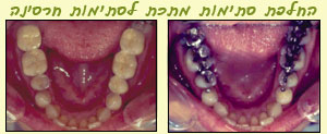 tipulim5